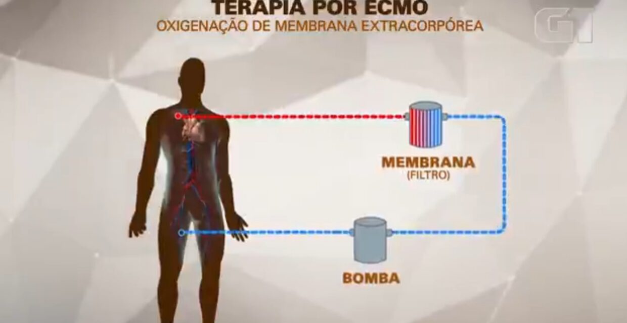 Terapia ECMO é utilizada em internação de MC Marcinho após parada cardiorrespiratória